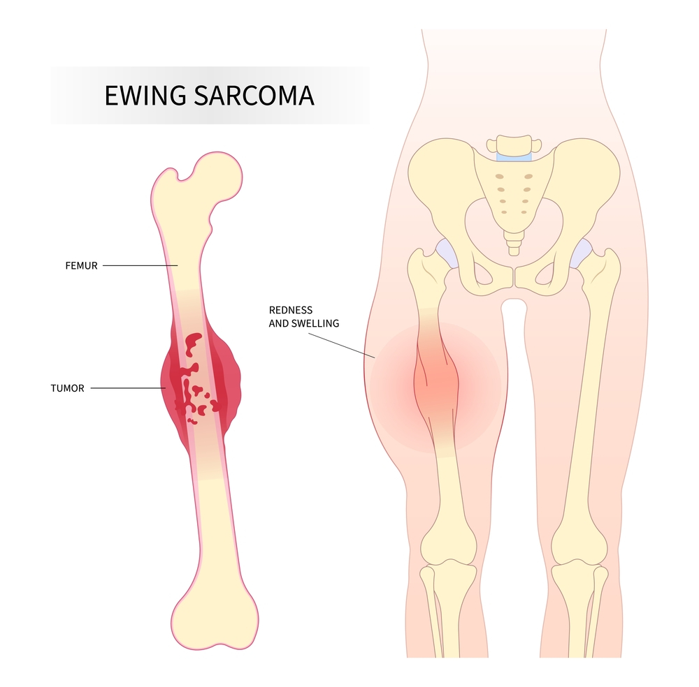 Bone and Soft tissue Sarcomas