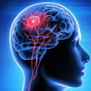 Brain Tumors Therapy in Hyderabad