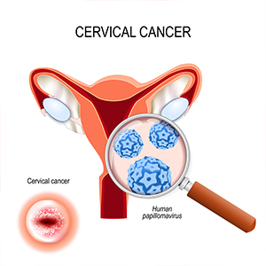 Cervix Cancer Screening in Hyderabad