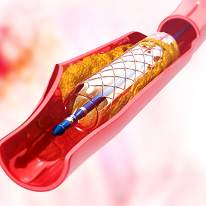 elective-angioplasty