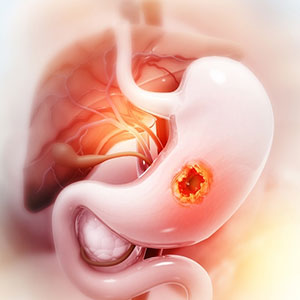 gastrointestinal-malignancies