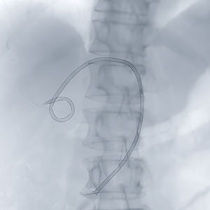 Complex Image guided angioplasties in Bandlaguda