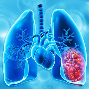 Lung cancer Screening in Hyderabad