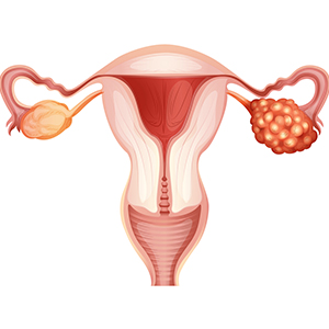 Ovarian cancer Screening in Hyderabad