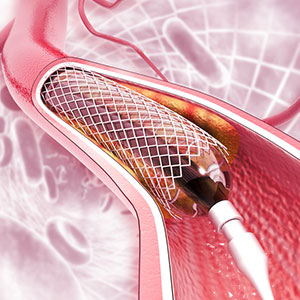 Acute Heart attack management with Primary angioplasty