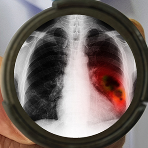 Lung and other thoracic malignancies