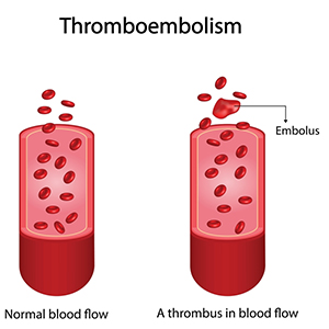 venous-thromboembolic-disorders